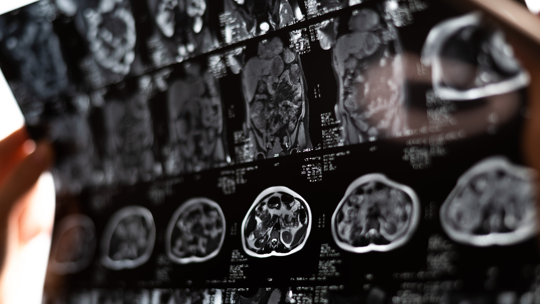 Implantes cerebrales prometen 'resetear' el ansia en adictos