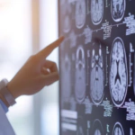 El estrés crónico podría aumentar el riesgo de accidente cerebrovascular en mujeres jóvenes