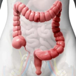 Cáncer de colon en jóvenes: detectan un vínculo entre mutaciones genéticas y una toxina de bacterias intestinales