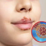 Científicos muestran cómo el herpes daña el cerebro y altera el comportamiento