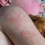 Brote de sarampión en EE.UU. supera los 1,000 casos y deja tres muertes